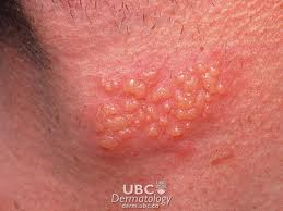 Viruses - image of Herpes Simplex Type-1