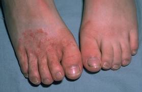 Wrestler  problems - Athlete's Foot