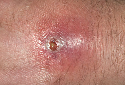 Wrestler  problems -MRSA Infection
